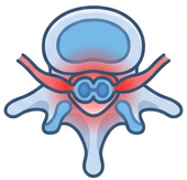 ARI-S Stenosis